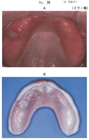 初診時の口腔内写真と粘膜調整材で裏装した義歯床粘膜面の写真