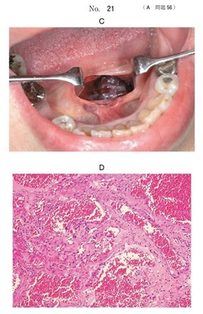 術中の口腔内写真及び摘出時のΗ-E染色病理組織像