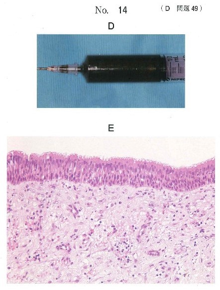 穿刺吸引時の内容液の写真及び生検時のΗ-E染色病理組織像