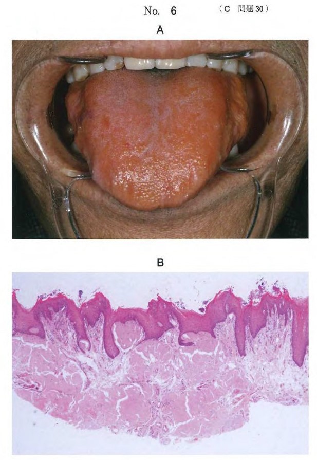 口腔内写真、生検時のΗ-E染色病理組織像