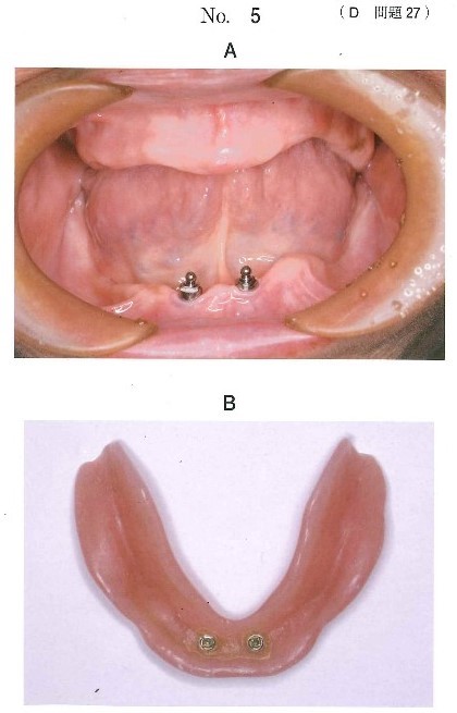 口腔内写真、使用中の義歯粘膜面の写真