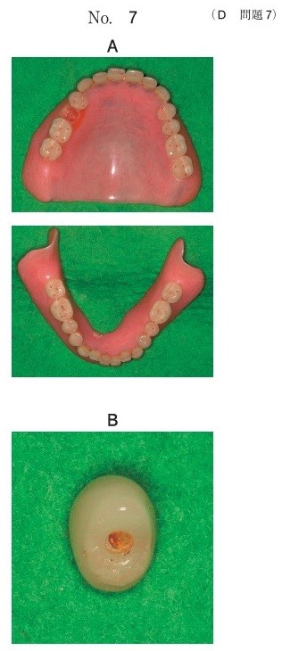 義歯の写真(別冊No.7A)と脱離した人工歯基底面の写真(別冊No.7B)