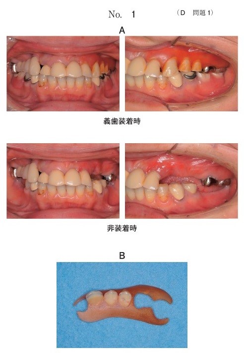 口腔内写真(別冊No.1A)と上顎義歯の写真(別冊No.1B)