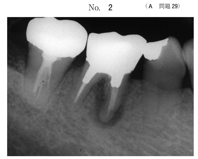 下顎右側第一大臼歯のエックス線写真(別冊No.2)