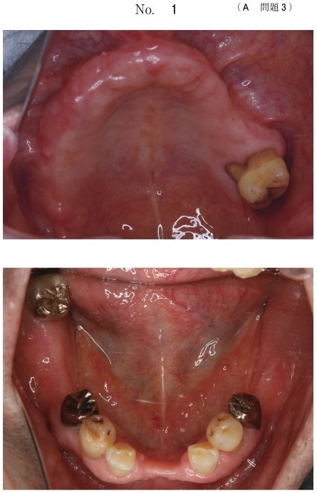 欠損歯列患者の口腔内写真(別冊No.1)