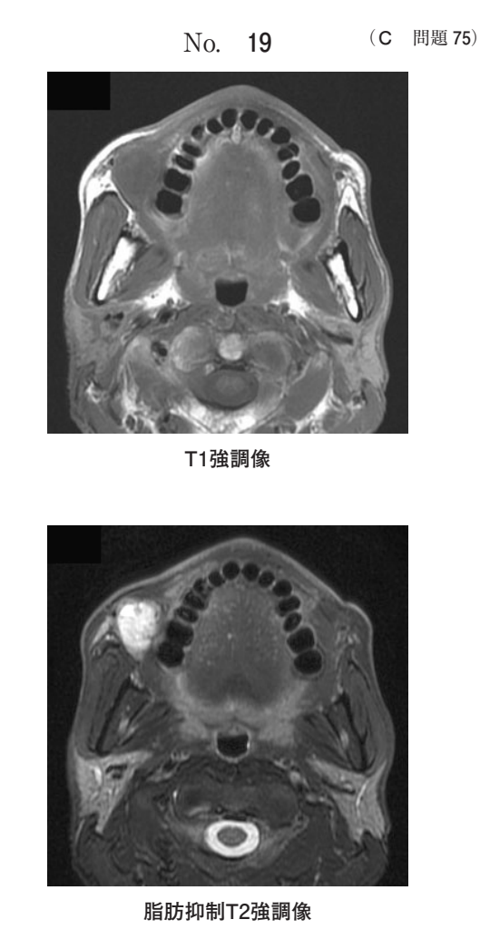 MRI T1強調像と脂肪抑制T2強調像(別冊No.19)
