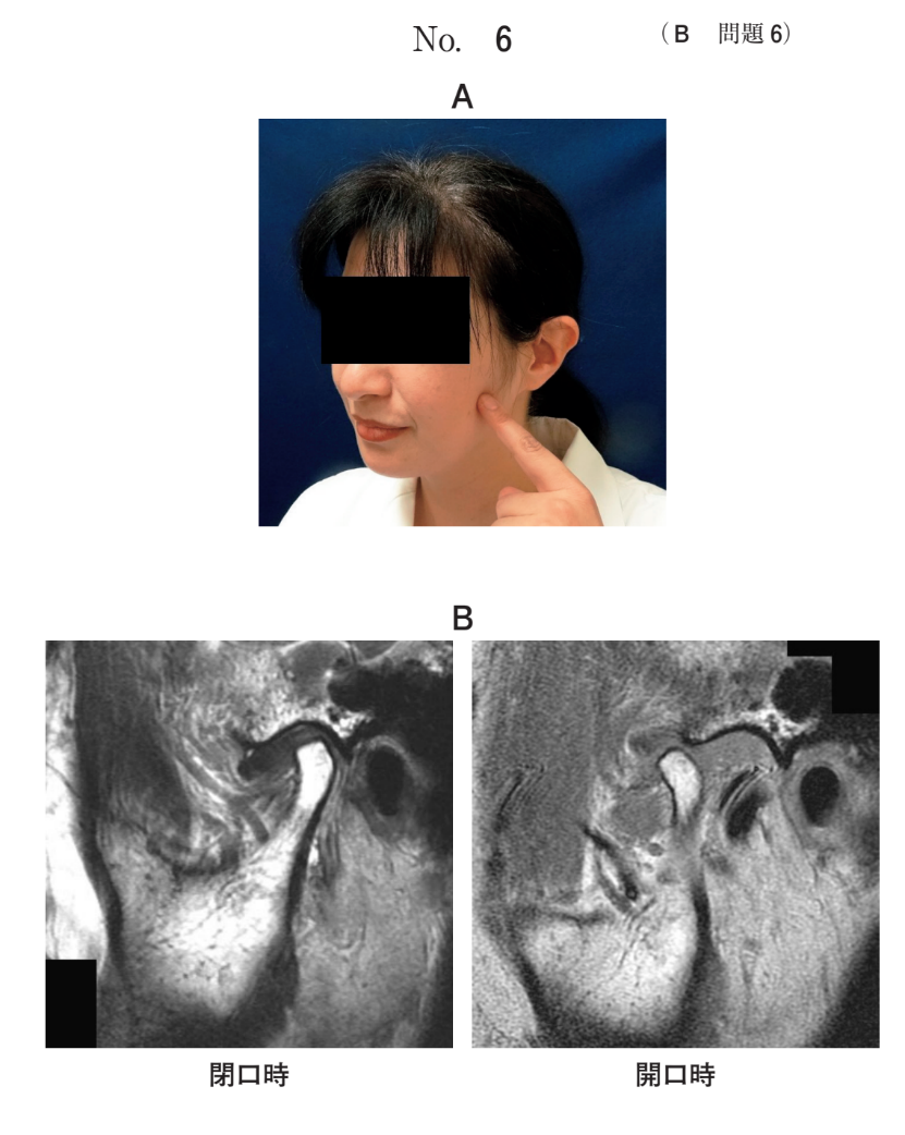 疼痛を認める部位を指した写真(別冊No.6A)と左側顎関節のMRI(別冊No.6B)