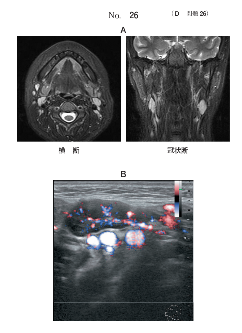 MRI脂肪抑制T2強調横断像と冠状断像(別冊No.26A)と、ドプラ法による超音波検査横断像(別冊No.26B)
