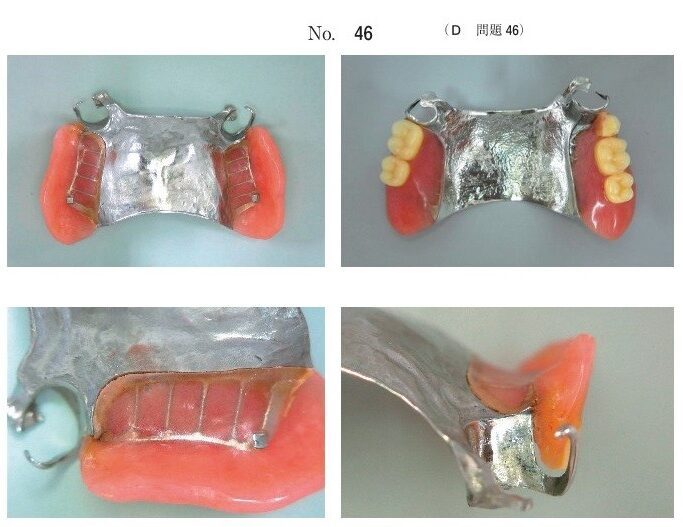 義歯の写真(別冊No.46)