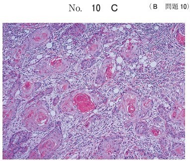 生検時のH-E染色病理組織像(別冊No.10C)