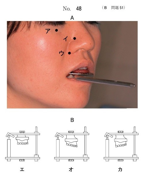 前方基準点を示した写真(別冊No.48A)と咬合器に上顎模型を装着した模式図(別冊No.48B)