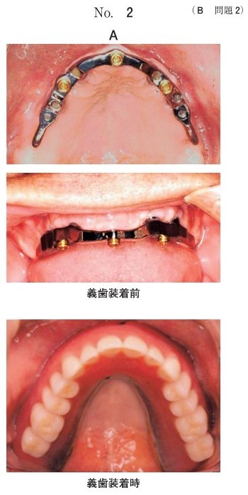上顎義歯装着前後の口腔内写真(別冊No.2A)