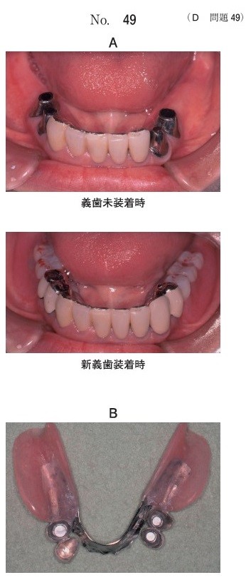 口腔内写真(別冊No.49A)と、義歯粘膜面観の写真(別冊No.49B)