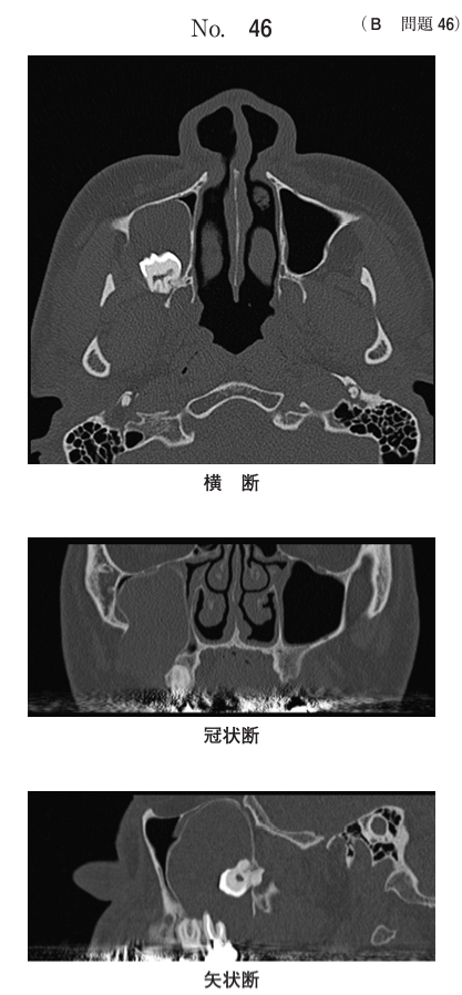 横断、冠状断および矢状断の骨表示CT(別冊No.46)