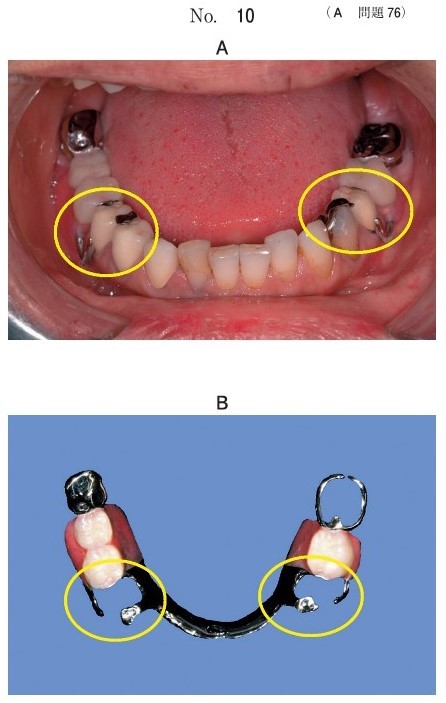 口腔内写真(別冊No.10A)と装着した義歯の写真(別冊No.10B)