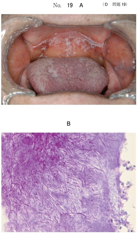 口腔内写真(別冊No.19A)と口腔粘膜からの剝離物のPAS染色塗抹標本像(別冊No.19B)