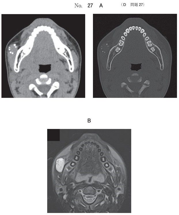 初診時のCT(別冊No.27A)とMRI脂肪抑制T2強調像(別冊No.27B)