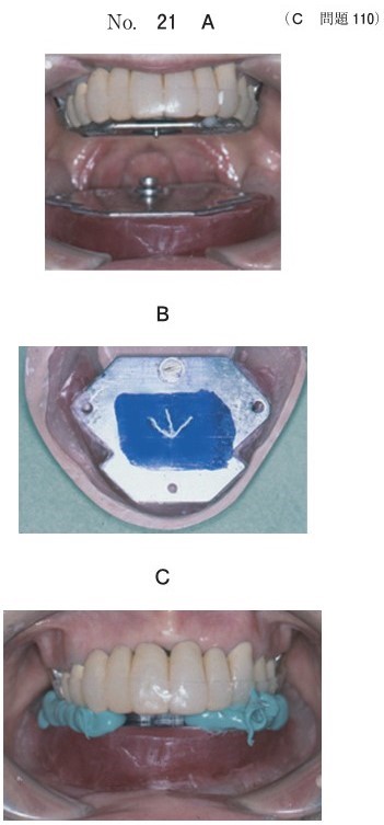 全部床義歯製作過程のある操作の写真(別冊No.21A、B、C)