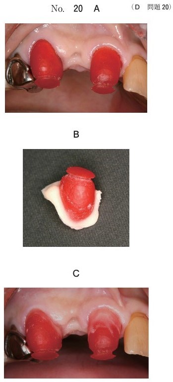 個歯トレー調整中の操作順の写真(別冊No.20A、B、C)