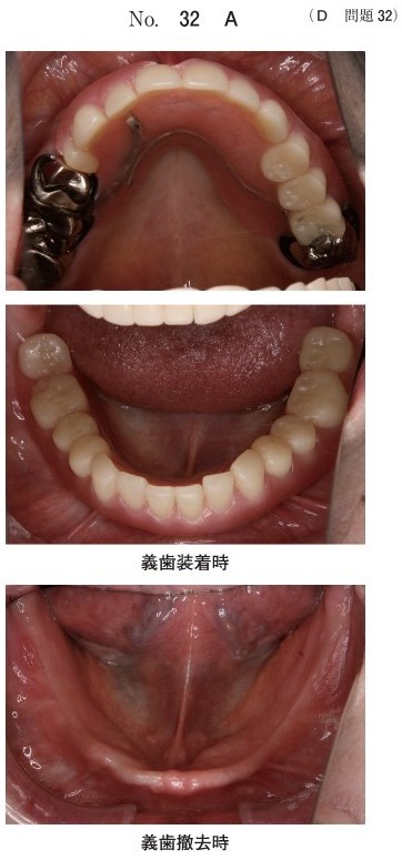 初診時の義歯装着時と義歯撤去時の口腔内写真(別冊No.32A)