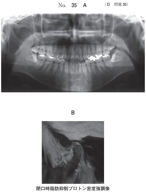 初診時のエックス線写真(別冊No.35A)と左側顎関節部の閉口時MRI(別冊No. 35B)