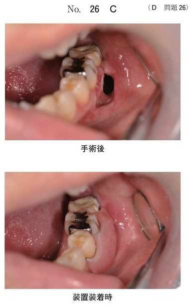 手術後と装置装着時の口腔内写真(別冊No.26C)