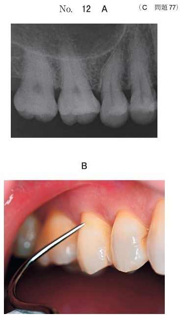 エックス線写真(別冊No.12A)と、原因歯を特定するための検査を実施中の口腔内写真(別冊No.12B)