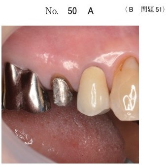 支台歯の写真(別冊No.50A)