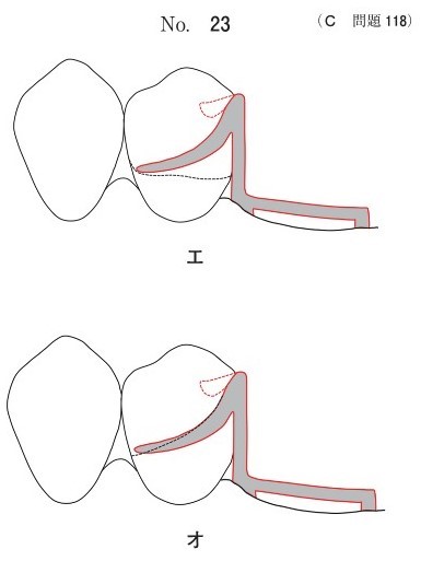 支台歯の模式図(別冊No.23)